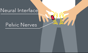 Pelvic nerve stimulation